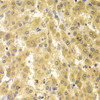 Immunohistochemistry of paraffin-embedded Human liver cancer using GMNN Polyclonal Antibody at dilution of  1:100 (40x lens).