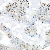 Immunohistochemistry of paraffin-embedded Human breast cancer using BACH1 Polyclonal Antibody at dilution of  1:100 (40x lens).