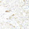 Immunohistochemistry of paraffin-embedded Human liver cancer using HSD17B10 Polyclonal Antibody at dilution of  1:100 (40x lens).