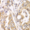 Immunohistochemistry of paraffin-embedded Human liver cancer using TXNRD2 Polyclonal Antibody at dilution of  1:100 (40x lens).