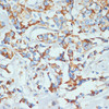Immunohistochemistry of paraffin-embedded Human breast cancer using DDX3X Polyclonal Antibody at dilution of  1:100 (40x lens).