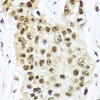 Immunohistochemistry of paraffin-embedded Human lung cancer using TET2 Polyclonal Antibody at dilution of  1:100 (40x lens).