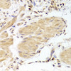 Immunohistochemistry of paraffin-embedded Human gastric cancer using Caspase-2 Polyclonal Antibody at dilution of  1:100 (40x lens).