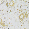 Immunohistochemistry of paraffin-embedded Human liver cancer using Caspase-2 Polyclonal Antibody at dilution of  1:100 (40x lens).
