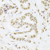 Immunohistochemistry of paraffin-embedded Human breast cancer using ANP32A Polyclonal Antibody at dilution of  1:100 (40x lens).