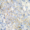 Immunohistochemistry of paraffin-embedded Human esophageal cancer using PRKCQ Polyclonal Antibody at dilution of  1:200 (40x lens).