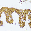 Immunohistochemistry of paraffin-embedded Human mammary cancer using SKIL Polyclonal Antibody at dilution of  1:100 (40x lens).