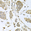 Immunohistochemistry of paraffin-embedded Human gastric cancer using SBDS Polyclonal Antibody at dilution of  1:100 (40x lens).