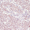 Immunohistochemistry of paraffin-embedded Human cervix cancer using SNRNP70 Polyclonal Antibody at dilution of  1:100 (40x lens).