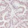 Immunohistochemistry of paraffin-embedded Human colon carcinoma using SNRNP70 Polyclonal Antibody at dilution of  1:100 (40x lens).