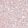 Immunohistochemistry of paraffin-embedded Human oophoroma using SNRNP70 Polyclonal Antibody at dilution of  1:100 (40x lens).