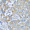 Immunohistochemistry of paraffin-embedded Human lung cancer using RARS Polyclonal Antibody at dilution of  1:100 (40x lens).