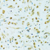 Immunohistochemistry of paraffin-embedded Human gastric cancer using RCC1 Polyclonal Antibody at dilution of  1:100 (40x lens).