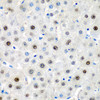 Immunohistochemistry of paraffin-embedded Human liver cancer using LMX1B Polyclonal Antibody at dilution of  1:200 (40x lens).