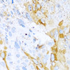 Immunohistochemistry of paraffin-embedded Mouse esophageal cancer using SPINT1 Polyclonal Antibody at dilution of  1:100 (40x lens).