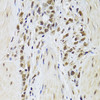 Immunohistochemistry of paraffin-embedded Human gastric cancer using SF1 Polyclonal Antibody at dilution of  1:100 (40x lens).