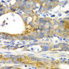 Immunohistochemistry of paraffin-embedded Human gastric cancer using GORASP1 Polyclonal Antibody at dilution of  1:100 (40x lens).