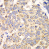 Immunohistochemistry of paraffin-embedded Human esophageal cancer using HAGH Polyclonal Antibody at dilution of  1:100 (40x lens).