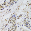 Immunohistochemistry of paraffin-embedded Human breast cancer using PPP1R8 Polyclonal Antibody at dilution of  1:100 (40x lens).