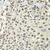 Immunohistochemistry of paraffin-embedded Human well-differentiated squamous skin carcinoma using PUF60 Polyclonal Antibody at dilution of  1:100 (40x lens).