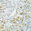 Immunohistochemistry of paraffin-embedded Human uterine cancer using RPS7 Polyclonal Antibody at dilution of  1:100 (40x lens).