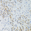 Immunohistochemistry of paraffin-embedded Human colon carcinoma using SRP19 Polyclonal Antibody at dilution of  1:100 (40x lens).