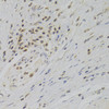 Immunohistochemistry of paraffin-embedded Human gastric cancer using TAF1C Polyclonal Antibody at dilution of  1:100 (40x lens).