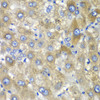 Immunohistochemistry of paraffin-embedded Human liver damage using TLK2 Polyclonal Antibody at dilution of  1:100 (40x lens).