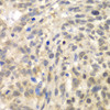 Immunohistochemistry of paraffin-embedded Human esophageal cancer using TLK2 Polyclonal Antibody at dilution of  1:100 (40x lens).