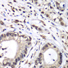 Immunohistochemistry of paraffin-embedded Human liver cancer using HNRNPM Polyclonal Antibody at dilution of  1:100 (40x lens).