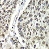 Immunohistochemistry of paraffin-embedded Human esophageal cancer using HNRNPM Polyclonal Antibody at dilution of  1:100 (40x lens).
