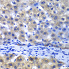 Immunohistochemistry of paraffin-embedded Human liver damage using PSMD8 Polyclonal Antibody at dilution of  1:100 (40x lens).