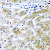 Immunohistochemistry of paraffin-embedded Human liver cancer using RARRES2 Polyclonal Antibody at dilution of  1:200 (40x lens).