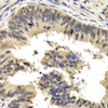 Immunohistochemistry of paraffin-embedded Human colon carcinoma using RBBP5 Polyclonal Antibody at dilution of  1:100 (40x lens).