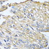 Immunohistochemistry of paraffin-embedded Human prostate cancer using CCL8 Polyclonal Antibody at dilution of  1:100 (40x lens).