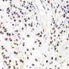 Immunohistochemistry of paraffin-embedded Human kidney cancer using SOX5 Polyclonal Antibody at dilution of  1:100 (40x lens).