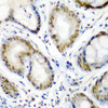 Immunohistochemistry of paraffin-embedded Human colon carcinoma using SS18 Polyclonal Antibody at dilution of  1:200 (40x lens).
