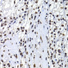 Immunohistochemistry of paraffin-embedded Human kidney cancer using mH2A1 Polyclonal Antibody at dilution of  1:100 (40x lens).