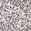 Immunohistochemistry of paraffin-embedded Human well-differentiated squamous skin carcinoma using DNAJB6 Polyclonal Antibody at dilution of  1:100 (40x lens).