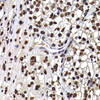 Immunohistochemistry of paraffin-embedded Human kidney cancer using DNAJB6 Polyclonal Antibody at dilution of  1:100 (40x lens).