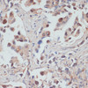 Immunohistochemistry of paraffin-embedded Human lung cancer using TES Polyclonal Antibody at dilution of  1:100 (40x lens).