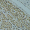 Immunohistochemistry of paraffin-embedded Human colon carcinoma using RSRC1 Polyclonal Antibody at dilution of  1:100 (40x lens).