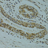 Immunohistochemistry of paraffin-embedded Human breast cancer using RSRC1 Polyclonal Antibody at dilution of  1:100 (40x lens).