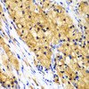 Immunohistochemistry of paraffin-embedded Human lung cancer using CAPG Polyclonal Antibody at dilution of  1:100 (40x lens).