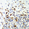 Immunohistochemistry of paraffin-embedded Human liver cancer using CAPG Polyclonal Antibody at dilution of  1:100 (40x lens).