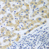 Immunohistochemistry of paraffin-embedded Human liver cancer using SHBG Polyclonal Antibody at dilution of  1:100 (40x lens).