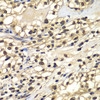 Immunohistochemistry of paraffin-embedded Human kidney cancer using ZNF169 Polyclonal Antibody at dilution of  1:100 (40x lens).