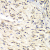 Immunohistochemistry of paraffin-embedded Human gastric cancer using CHEK1 Polyclonal Antibody at dilution of  1:100 (40x lens).