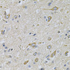 Immunohistochemistry of paraffin-embedded Human brain cancer using RAB17 Polyclonal Antibody at dilution of  1:100 (40x lens).