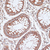 Immunohistochemistry of paraffin-embedded Human colon carcinoma using KCNS3 Polyclonal Antibody at dilution of  1:100 (40x lens).